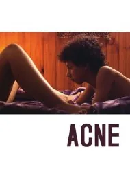 آکنه (Acne)