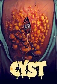 کیست (Cyst)